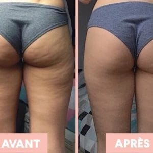 centre traitement cellulite toulouse
